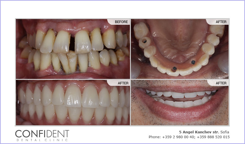 Teeth Express System, Upper and lower jaw, Temporary bridges, first stage 